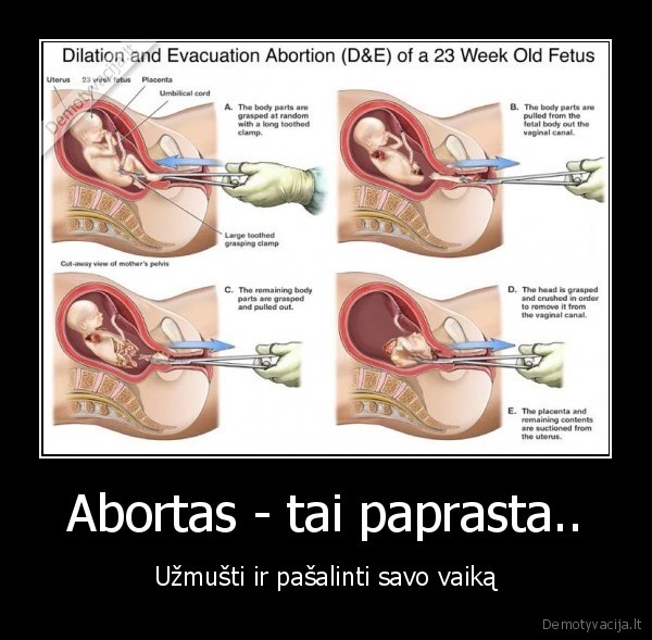 Abortas - tai paprasta.. - Užmušti ir pašalinti savo vaiką