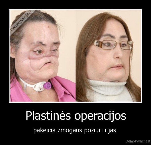 Plastinės operacijos - pakeicia zmogaus poziuri i jas 